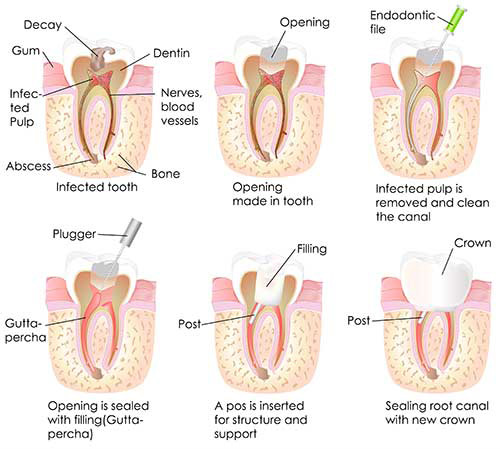 Toms River Root Canal