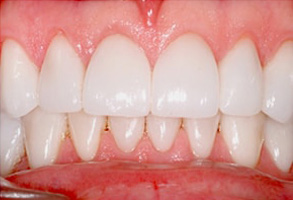 Toms River Before and After Dental Implants