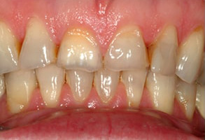 Toms River Before and After Teeth Whitening