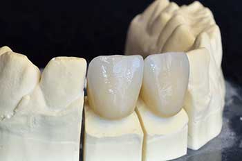 Dental Crowns in Toms River