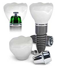 Toms River Dental Implants