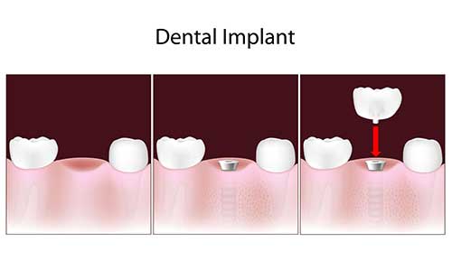 Implant Dentist in Toms River