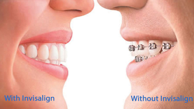 Toms River Invisalign