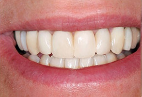 Toms River Before and After Dental Implants