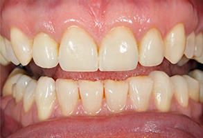 Before and After Veneers