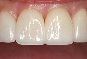 Before and After Veneers