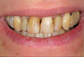 Toms River Before and After Teeth Whitening